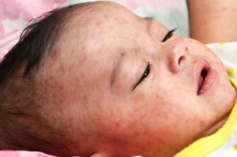 <b><span style="color:red;">ÜST:  Qızılca bəzi ölkələrdə epidemiya halını alıb</b>