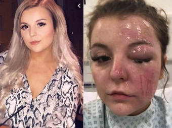 <span style="color:red;">DƏHŞƏT:  yumurta bişirdi, bir gözünü itirdi-<span style="color:red;">FOTO 