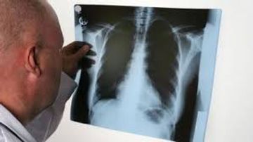 Azərbaycanda vərəm xəstələrinin sayı azalıb