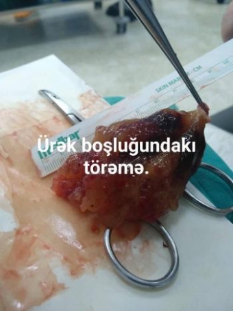 42 yaşlı qadının ürəyindən 8,5 sm-lik törəmə çıxarıldı - DTX-nin hospitalında - FOTO
