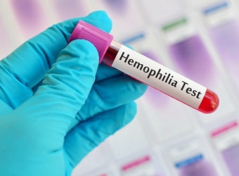 Azərbaycanda 4 hemofiliyalı xəstə öldü