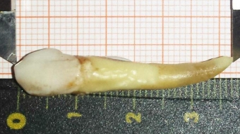 Yeni dünya REKORDU: həkim ən uzun dişi çəkdi və...