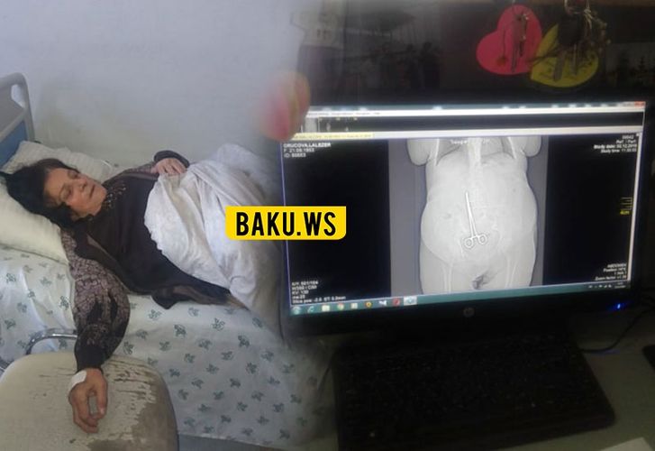 Qadının qarın boşluğunda qayçı qalması ilə bağlı RƏSMİ MƏLUMAT