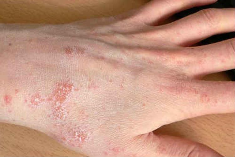 Azərbaycanda qarayara, qoturluq xəstəliklərinin sayı artıb