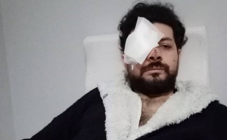 Güllə müğənninin gözünə dəydi - FOTO