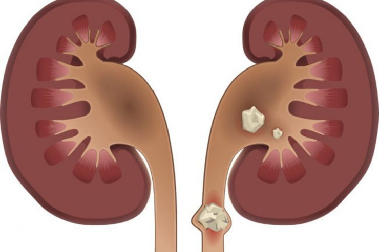 D vitamini çox qəbul edildikdə nə baş verir? – HƏKİM DANIŞDI  