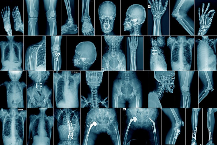 Zədələnmiş sümük dəqiqələr sonra bərpa olunacaq - TİBBDƏ İNQİLAB 