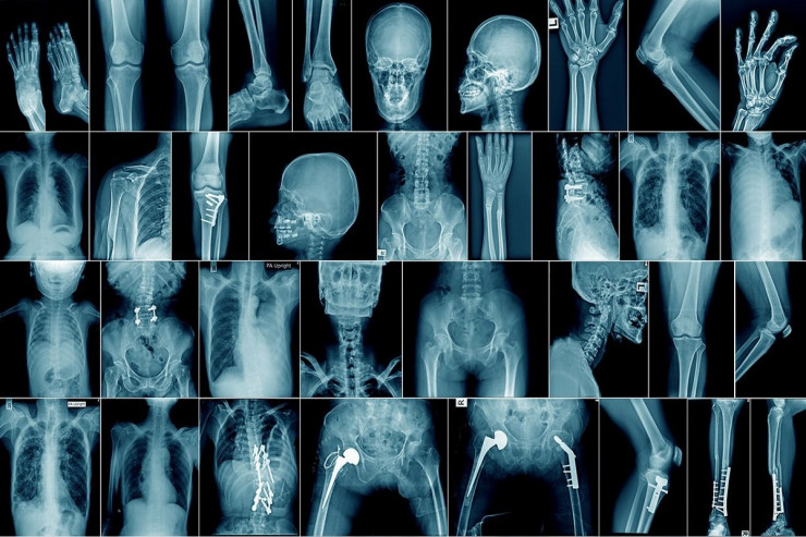 Sümüklərə inteqrasiya edilən naqilsiz mikrokompüter  yaradıldı - FOTO 