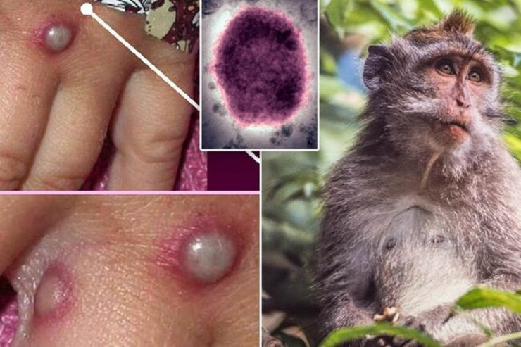 Meymunçiçəyi təhlükəsi ilə bağlı baş infeksionistdən  XƏBƏRDARLIQ 