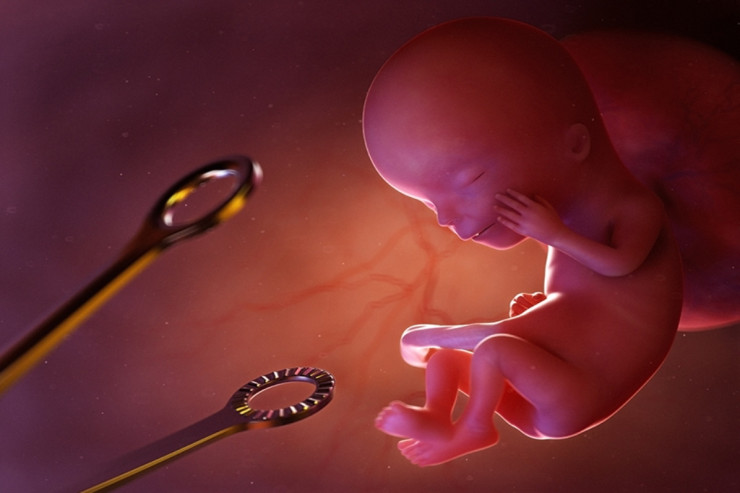 Azərbaycanda  abortlarla bağlı   DƏHŞƏTLİ STATİSTİKA