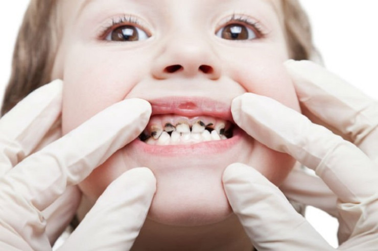 Xarab dişlər insanda hansı xəstəlikləri yaradır? - CAVAB 