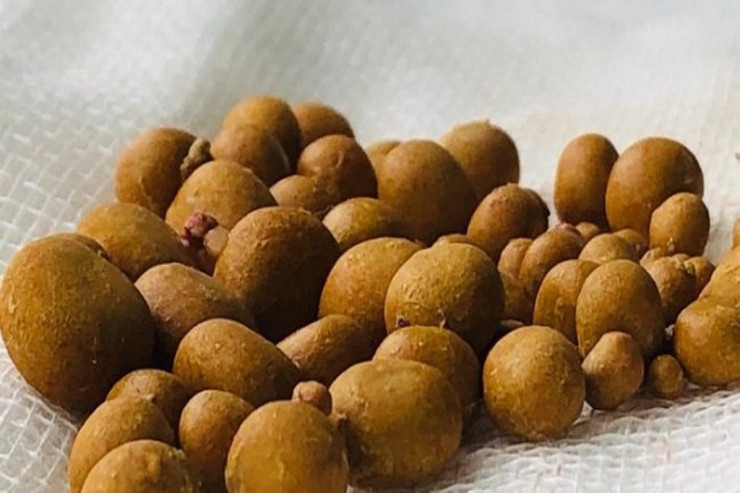 Xəstənin böyrəyindən  200-dən çox daş   çıxarıldı