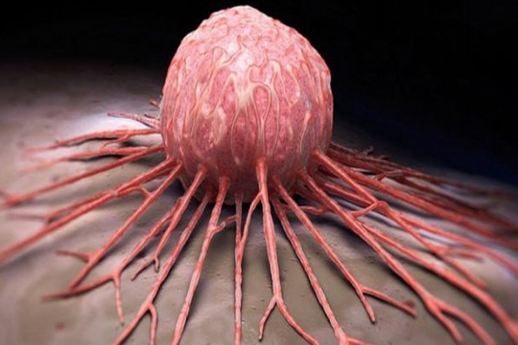 Çətin müalicə olunan xərçəng şişləri belə məhv ediləcək –  YENİ KƏŞF 