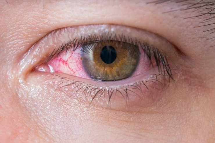 Koronavirus  gözə necə təsir edir?   - Həkim AÇIQLADI