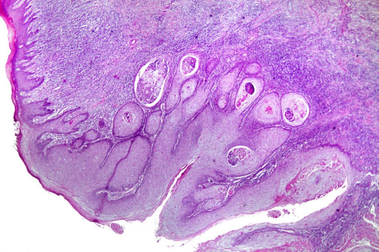 Xərçəng yarananda immun sistemdə NƏ BAŞ VERİR ? 