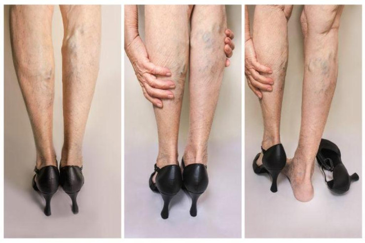 1 dəqiqəyə varikoz damarları MÜƏYYƏN ETMƏK 