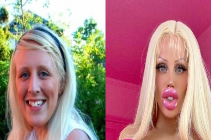 Barbiyə oxşamaq üçün 130 min dollar xərclədi - İnanılmaz dəyişim 