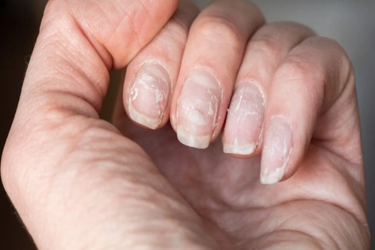 Dırnaqlarınızda ağ ləkələriniz var? – DİQQƏTLƏ OXUYUN 