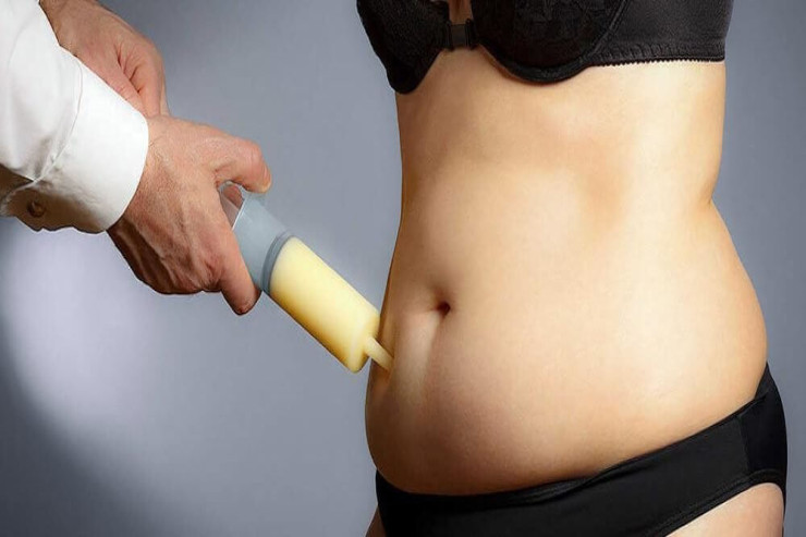 Arıqlamağın  MÜASİR TƏHLÜKƏSİ:   Liposaksiyadan sonra qayıdan piylər