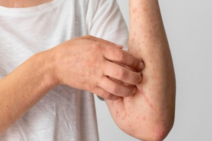 Qızılca xəstəliyində  hansı ağırlaşmalar   mümkündür? - MÜSAHİBƏ 