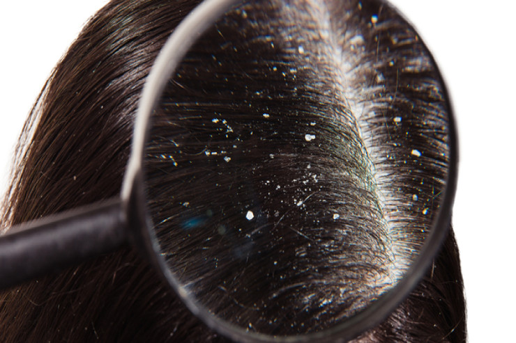 Kəpək  saç tökülməsinə,   daha nələrə səbəb olurmuş