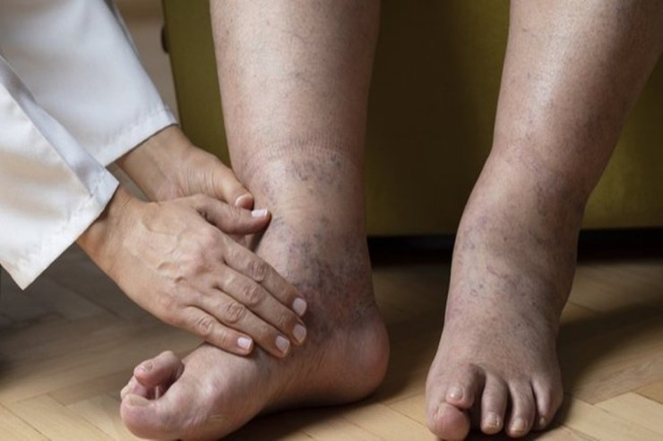 Ödəmin atılmasının başqa üsulu AÇIQLANDI 