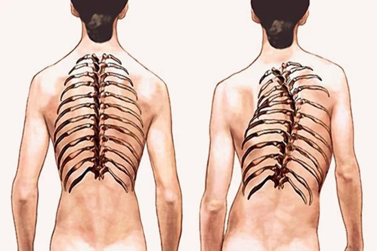 Fəqərə sürüşməsi nədir? - CAVAB 