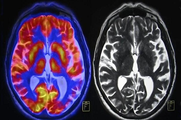 İnsanların beyni kiçilir:  IQ səviyyəsi   ilə bağlı XƏBƏRDARLIQ