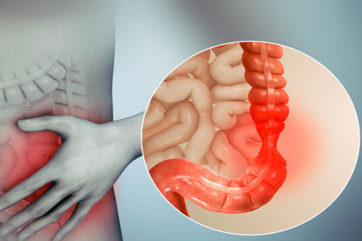 Düz bağırsaq xərçənginin  4 əsas əlaməti 