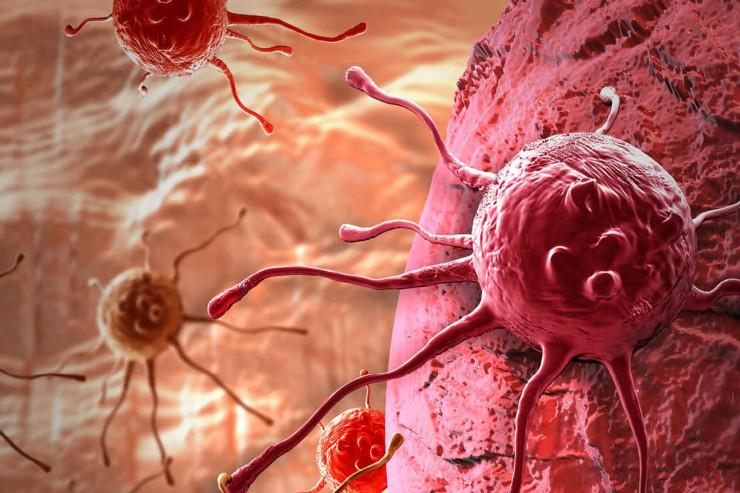 Xərçəng riskini artıran əsas iki amil 