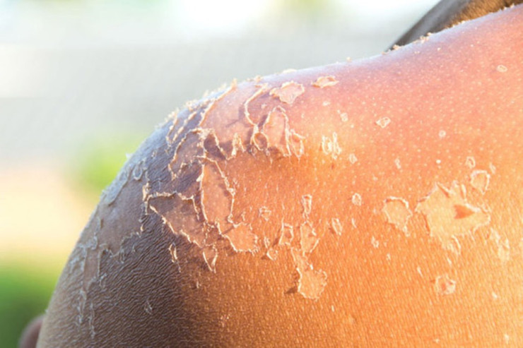 Çimərliyin ziyanı xeyrindən çoxdu? - MÜTƏXƏSSİS DANIŞIR 