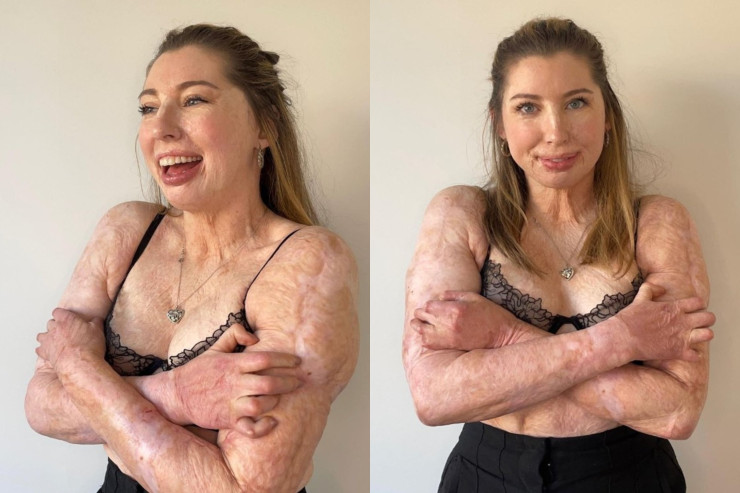 19 yaşında bədəninin 96 faizi yanan qızın  HƏYAT HEKAYƏSİ  