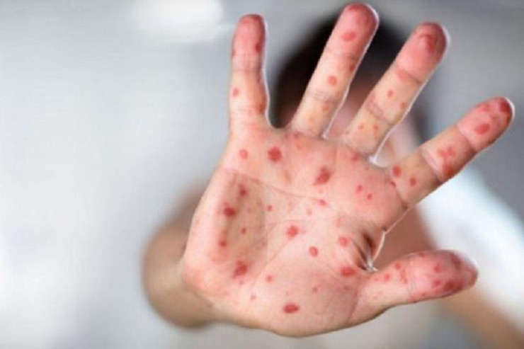 Azərbaycanda ŞOK:  qızılcaya yoluxan azyaşlı öldü - YENİLƏNİB 