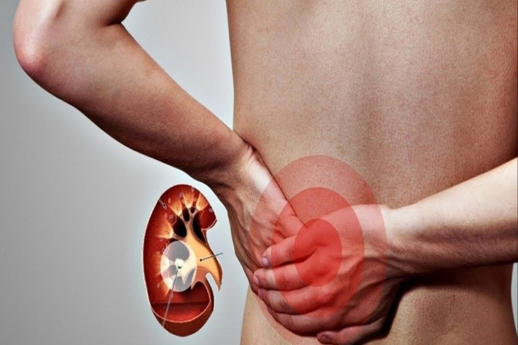 Böyrək xəstəliyinin sürətlə artmasının ƏSAS SƏBƏBİ – Həkimlə MÜSAHİBƏ 