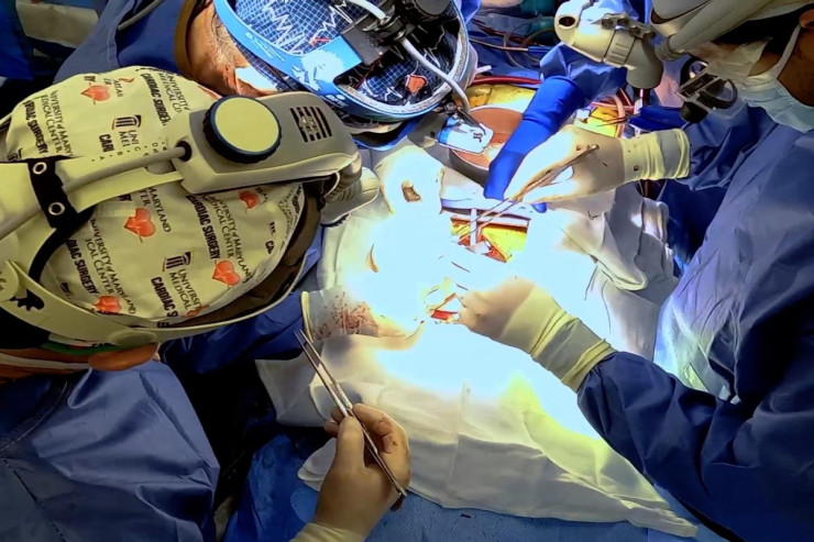 Daha bir insana  donuz ürəyi köçürüldü 