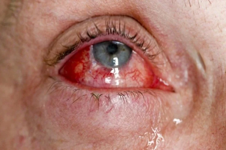 Yoluxucu “qırmızı göz”  xəstəliyi sürətlə yayılır