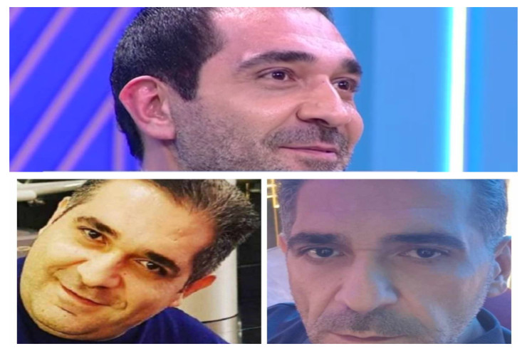 Nurlan Əzizbəyli  estetik əməliyyatdan   sonra