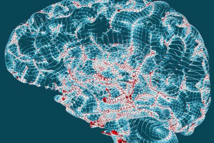 İnsultun qarşısını BU YOLLA  almaq olar