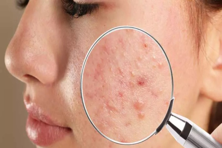 Qışda üzdə niyə sızanaqlar çıxır? - KOSMETOLOQ AÇIQLADI 