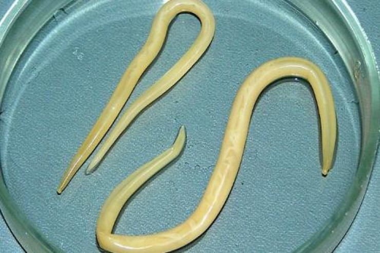 17 yaşlı qızın gözündən  12 santimetrlik QURD ÇIXARILDI 