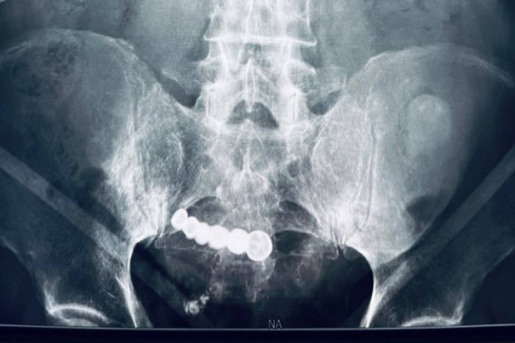 Pensiyaçı altı il bağırsaqlarında diş protezləri  ilə yaşadı