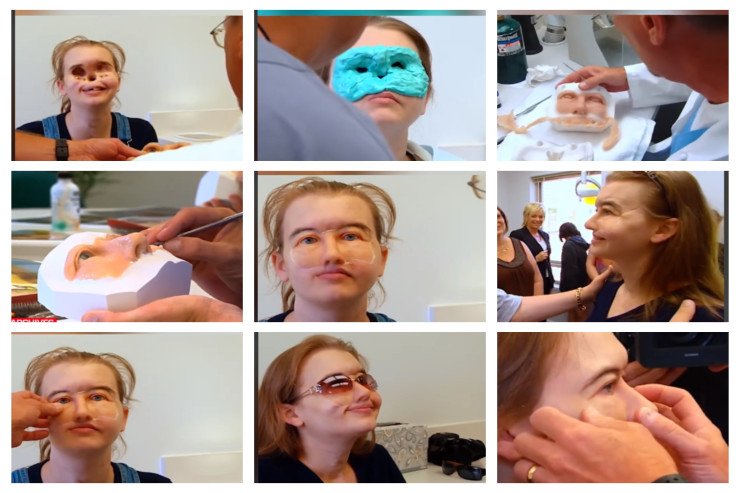 Həkimlər  üzü olmayan qıza   üz düzəltdilər