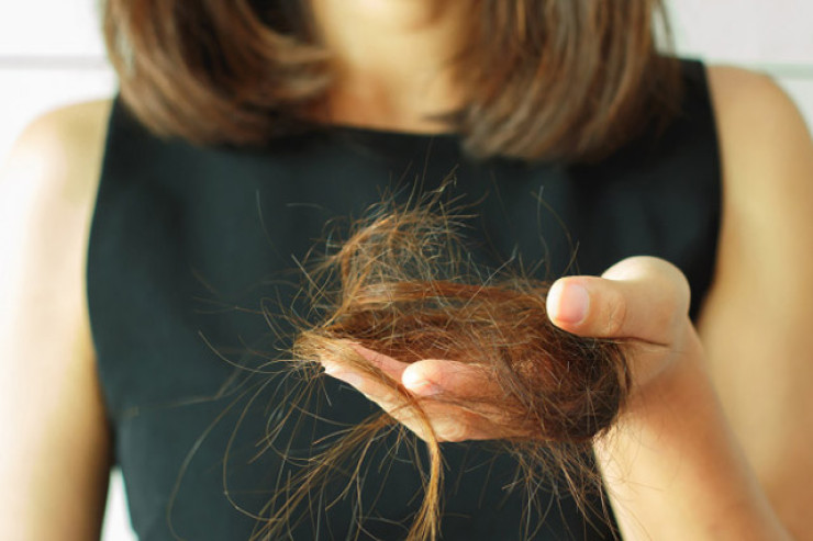 Qadın alopesiyası:  keçəlliyin   qarşısını almaq üçün nə etməli?