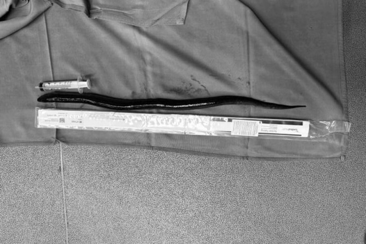 İnsanın mədəsindən canlı ilan balığı  çıxarıldı