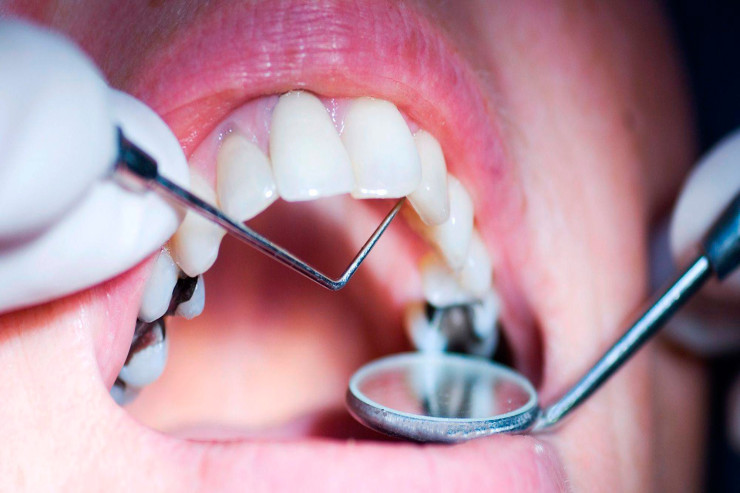 Kariyes hansı xəstəliklərə  gətirib çıxara bilər? 