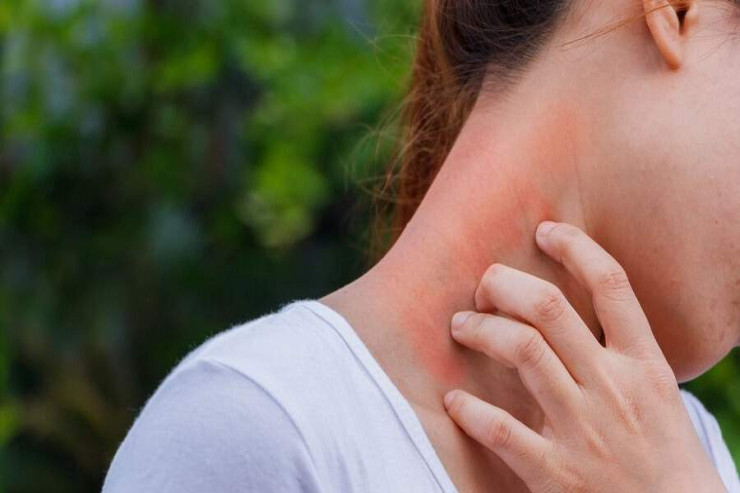 Günəş allergiyası barədə nə bilməliyik? 