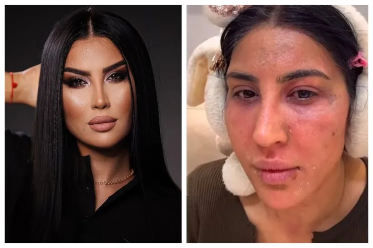 Reklam etdiyi pilinq Ləmanın üzünü yandırdı - Video 