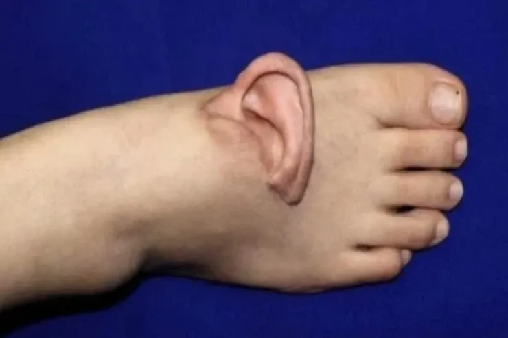 Cərrahlar qadının qopan qulağını  ayağına tikdilər: nə oldu