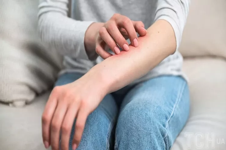 Dəriniz hissə-hissə soyulur:  Necə müalicə etmək  olar?