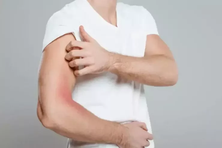 Bədəninizdəki qaşınma:  Bunun 4 fərqli xərçəng növü  əlaməti ola biləcəyi XƏBƏRDARLIĞI 